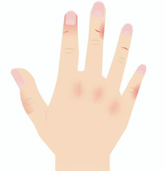 切り傷 あかぎれ,ひび,手,乾燥,指,傷,皮膚,痛み,切り傷,怪我のイラスト素材