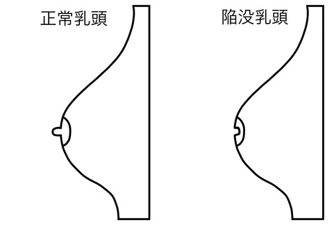 正常と陥没乳頭比較 線画 正常と陥没乳頭比較 線画 正常,比較,陥没,乳頭,線画のイラスト素材