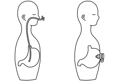 経鼻胃管と胃瘻比較 線画 経鼻胃管と胃瘻比較 線画 経鼻,経管,胃瘻,胃管,比較,線画のイラスト素材