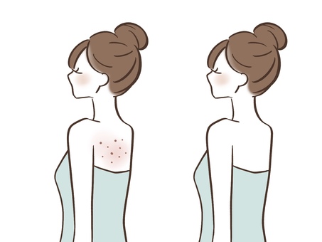 背中ニキビ ビフォーアフターのイラスト 女性,身体,美肌,美容,人物,シンプル,お手入れ,エステ,ツルツル,保湿のイラスト素材