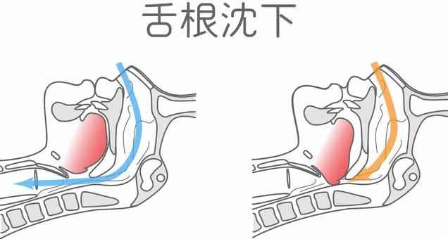 舌根沈下 舌根沈下,睡眠時無呼吸症候群,頭部断面図,呼吸,気道,閉鎖,睡眠時のイラスト素材