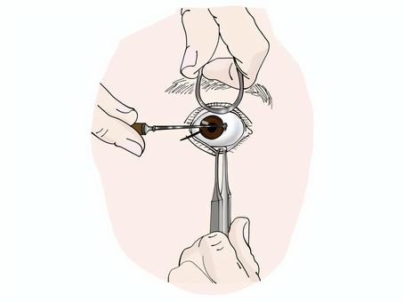 眼科外科手術 眼球,手術,瞼,眉毛,手,施術道具のイラスト素材