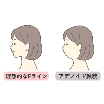 アデノイドとEラインの横顔女性 アデノイド,eライン,女性,顎,横顔,アデノイド顔貌,口ゴボ,人物,白背景,手描きのイラスト素材