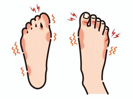 しもやけ、赤切れ　足 しもやけ,赤切れ,あかぎれ,足,冬,かゆい,痒み,痛い,皮膚,トラブルのイラスト素材