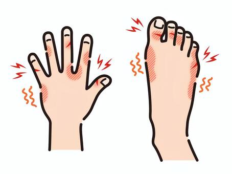 しもやけ、赤切れ　手足 しもやけ,赤切れ,あかぎれ,手,冬,かゆい,痒み,痛い,皮膚,トラブルのイラスト素材