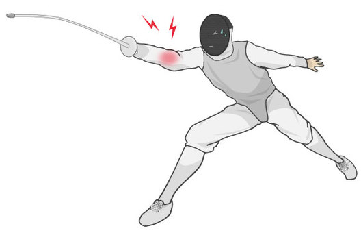 Illustration, fencing, injury, elbow, 