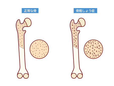 骨粗しょう症のイラストセット 骨粗しょう症,骨粗鬆症,骨密度,骨,加齢,老化,骨強度のイラスト素材
