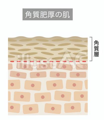 角質肥厚 断面図