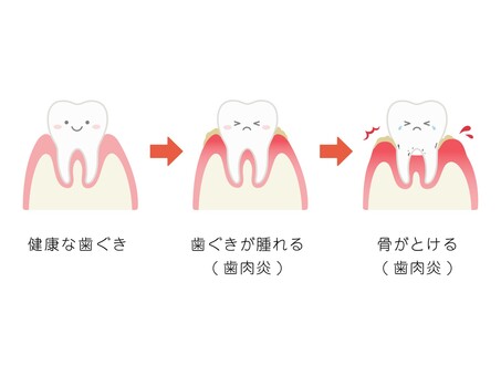 歯科　歯周病の進行の説明　文言・顔付き 歯科,歯周病,説明,歯肉炎,歯周炎,歯槽膿漏,歯ぐき,歯茎,歯肉,炎症のイラスト素材