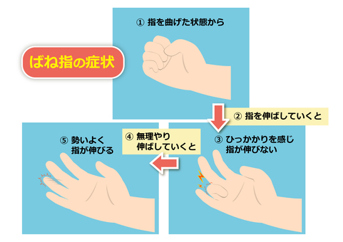 ばね指の症状 ばね指,指,ばね,手,医療,医学,腱鞘炎,弾発指,症状,図解のイラスト素材