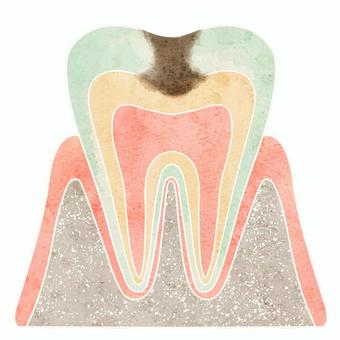 Cross section of cavities (C2), ضرس, المقطع العرضي, تسوس, JPG and PNG