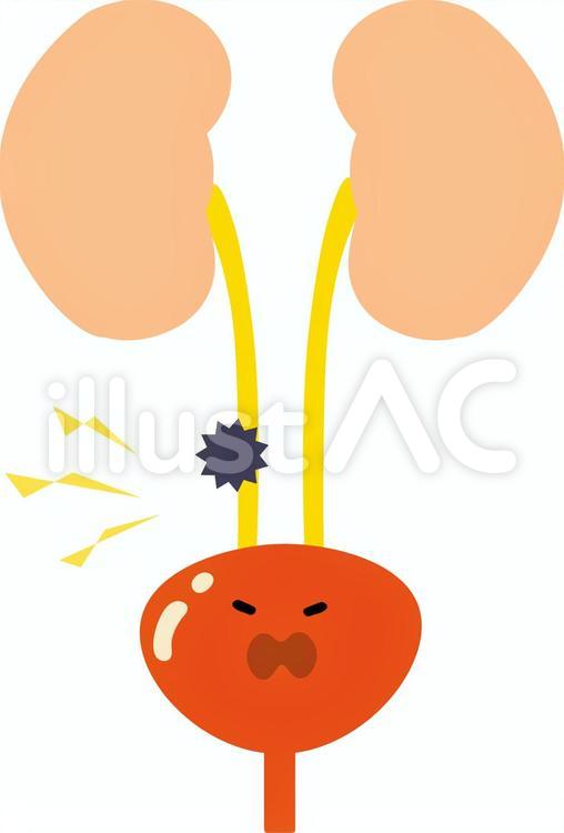 顔つき　尿管結石 顔つき,尿管結石,結石のイラスト素材