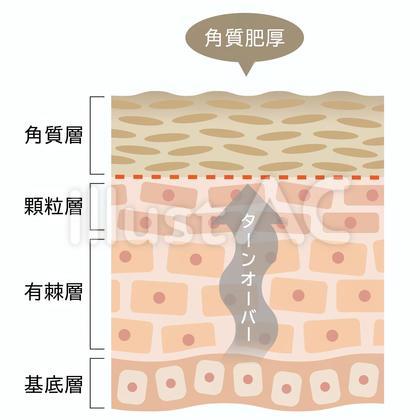 角質肥厚 肌の断面図
