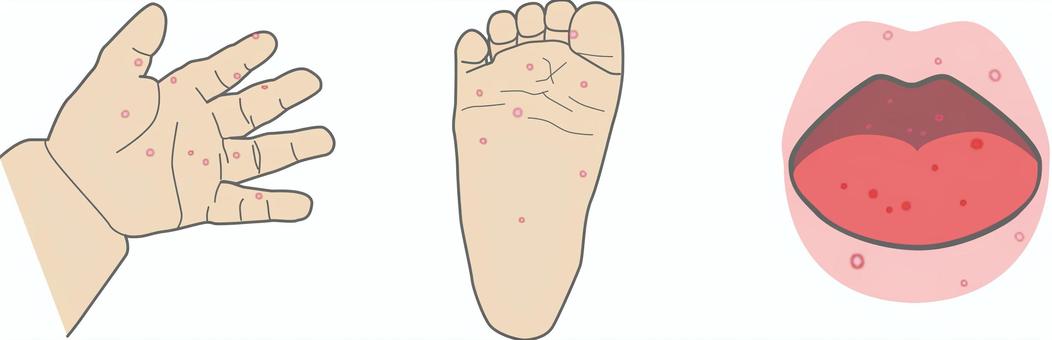 手足口病 手足口病,発疹,手,足,唇,舌,のど,ウイルス感染,幼児,乳幼児のイラスト素材