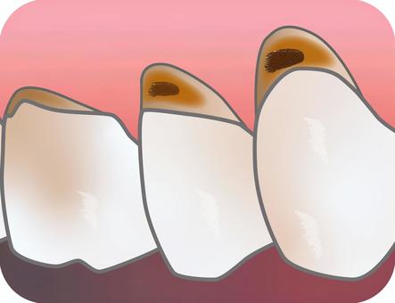 根面う蝕_2 歯,奥歯,根面う蝕,歯根,象牙質,歯ぐき,エナメル質,むし歯,歯頚部のイラスト素材