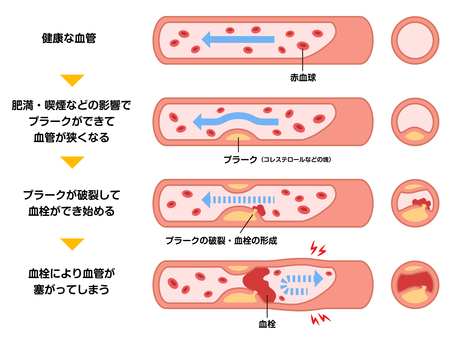 動脈硬化の発生と進行 動脈硬化,プラーク,コレステロール,心筋梗塞,脳梗塞,喫煙,肥満,血管,血栓,血流のイラスト素材