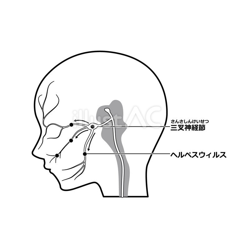 三叉神経とヘルペスウィルス（白黒） 三叉神経,ヘルペス,ウィルスのイラスト素材