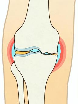 変形性膝関節症（正面・輪郭あり） 膝,右膝,関節,軟骨,大腿骨,脛骨,腓骨,関節液,関節包,滑膜のイラスト素材
