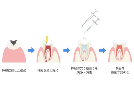 虫歯の治療説明（抜髄～根充まで）2　改 虫歯,歯科,歯,治療,説明,流れ,抜髄,根治,治療説明,歯科治療のイラスト素材