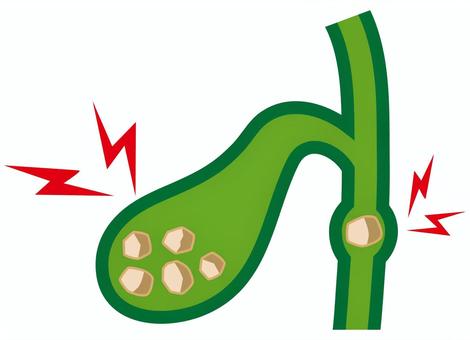 胆のうと胆石 胆のう,胆石,臓器,病気,人体,胆管,医療,結石,内蔵のイラスト素材