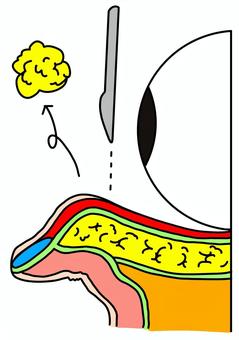 眼窩脂肪を除去　横からカラー 眼窩脂肪,メス,断面,美容整形,外科,カラーのイラスト素材