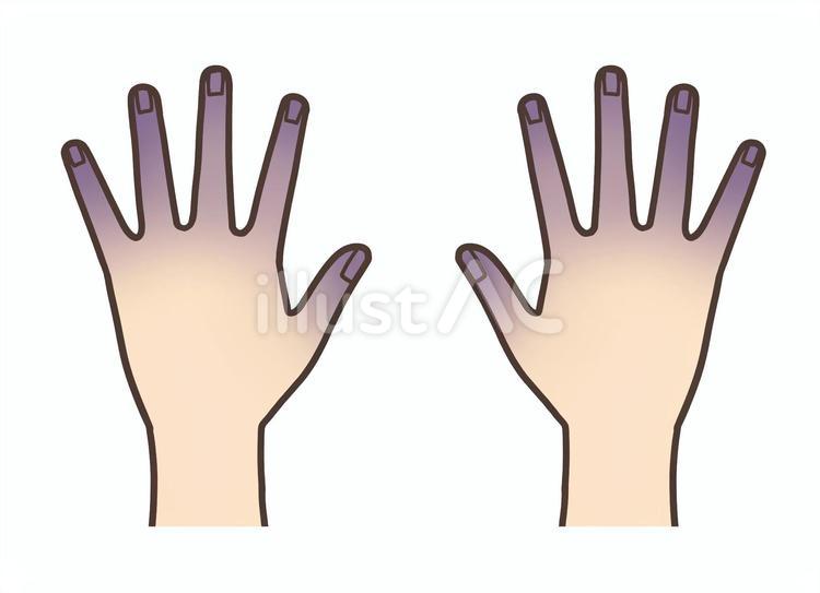 抹消性チアノーゼによる指先の紫色の変色 チアノーゼ,指先,紫色のイラスト素材
