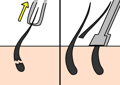 毛を抜く、毛を剃る 毛,剃る,抜く,断面,カラーのイラスト素材