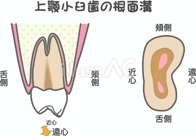 上顎小臼歯の根面溝 根面溝,上顎,小臼歯のイラスト素材