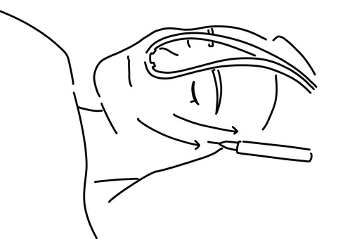 糸リフト刺入中　線画 糸リフト,アンチエイジング,美容外科,美容整形,麻酔,線画のイラスト素材