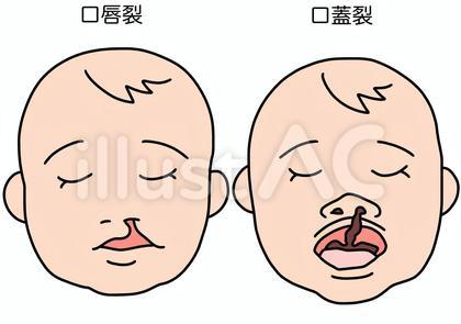 口唇裂と口蓋裂 文字ありカラー