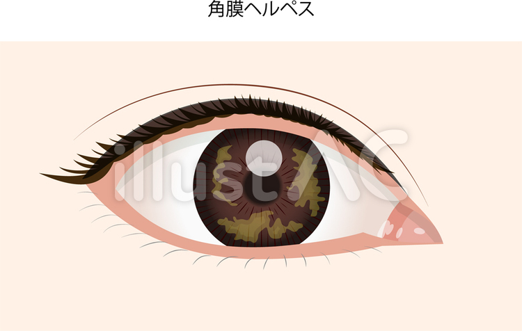 目の病気 眼の病気,病気,眼のイラスト素材