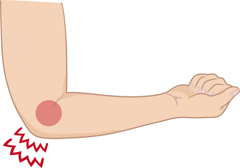 肘のしびれ 肘のしびれ 腕,上腕,前腕,肘,手,手首,指,関節,痛い,痛みのイラスト素材