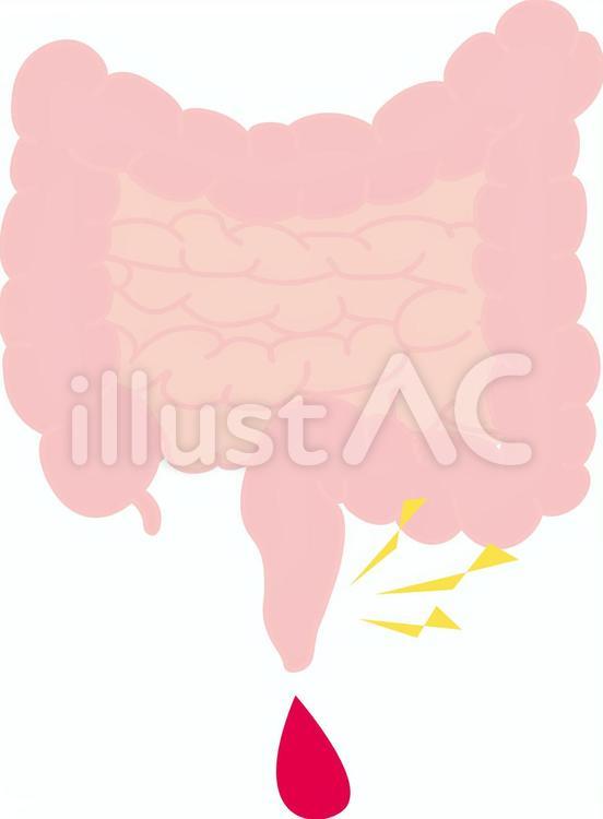 大腸　切れ痔 切れ痔,腹痛,脳のイラスト素材