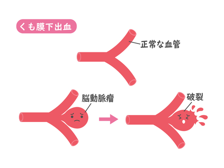 くも膜下出血1 くも膜下出血,血管,脳動脈瘤,医療,出血,破裂,病気,かわいい,イラスト,素材のイラスト素材