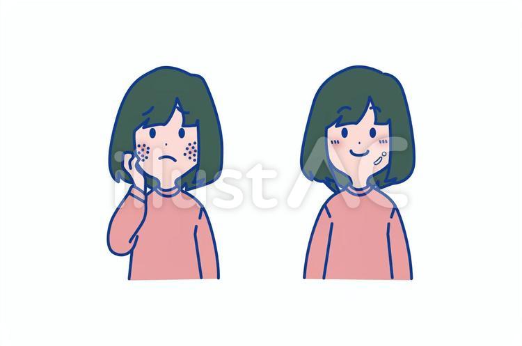 肌荒れの女の子 美容,女性,肌のイラスト素材