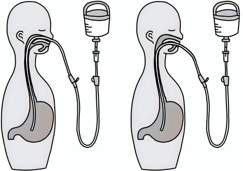 経管栄養の挿入位置比較 白黒 経管栄養の挿入位置比較 白黒 経管栄養,注入,経鼻,経口,白黒のイラスト素材