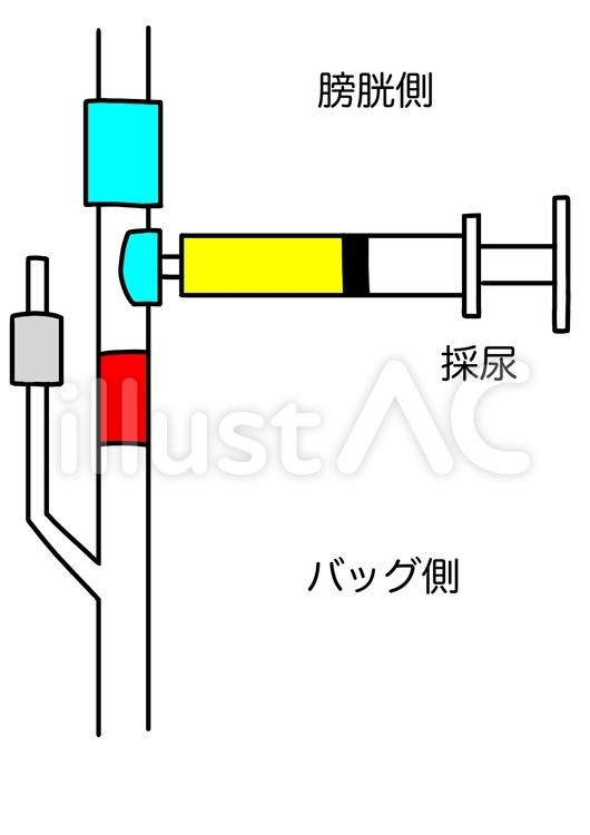 膀胱留置カテーテル　採尿イメージ　カラー 膀胱,尿道,カテーテルのイラスト素材