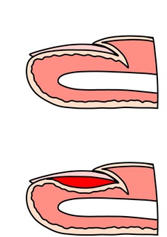正常と皮下血腫 指と爪カラー 正常と皮下血腫 指と爪カラー 正常,皮下血腫,爪,指,カラーのイラスト素材