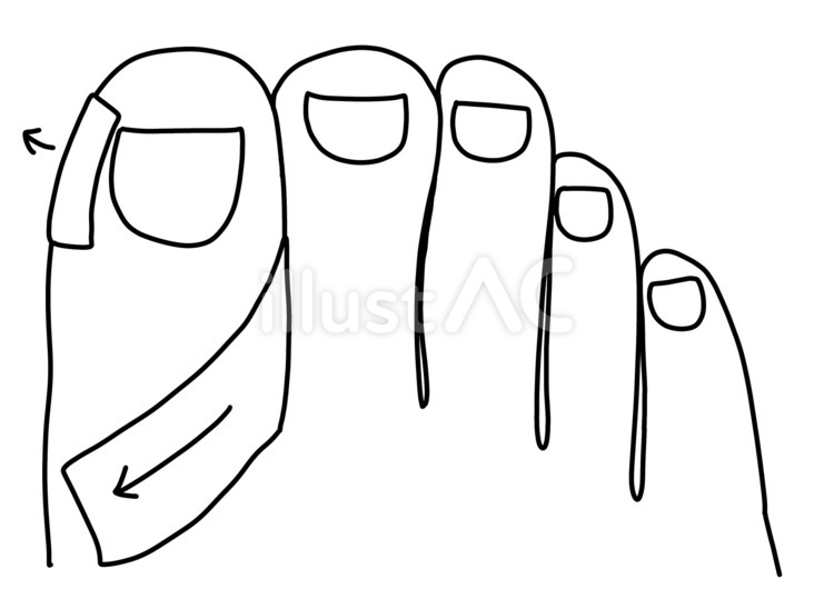巻き爪に対するテーピング　上から線画 巻き爪,テーピング,処置のイラスト素材