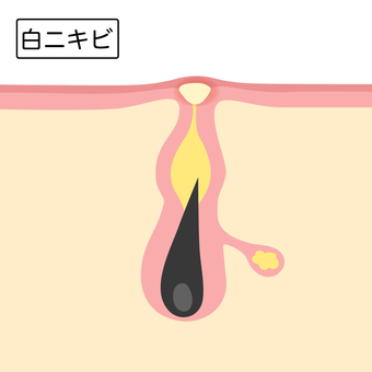 白色粉刺, 粉刺, 毛孔, 皮肤, JPG, PNG 和 AI
