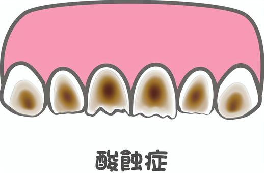 酸蝕症 酸蝕症,歯,前歯,歯科,むし歯,歯科健診,酸,溶ける,エナメル質,象牙質のイラスト素材