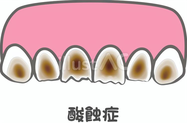 酸蝕症 酸蝕症,歯,前歯のイラスト素材