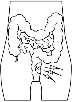 直腸付近の腫瘍　線画 直腸,腫瘍,異常,ガン,大腸,線画のイラスト素材