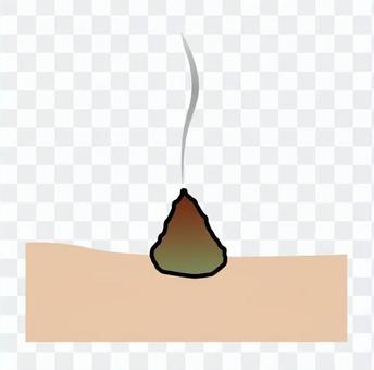 Moxibustion treatment Moxibustion treatment