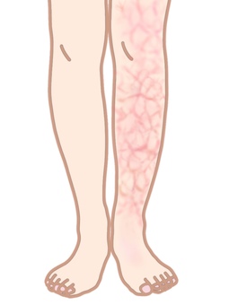 Low temperature burns One leg erythema Low temperature burns One leg erythema