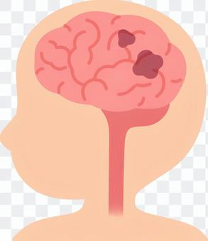 Brain (vascular dementia) Brain (vascular dementia)