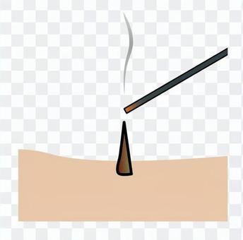 Moxibustion treatment Moxibustion treatment