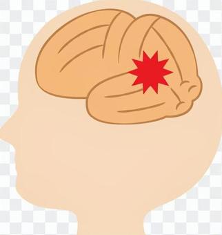 Cerebrovascular disease _ Wernicke Cerebrovascular disease _ Wernicke