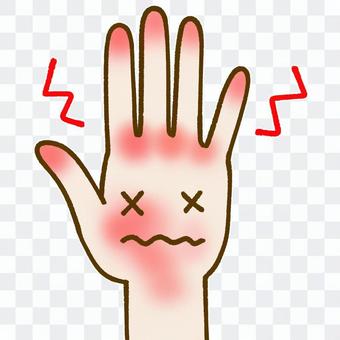手荒れした手 片手2 手荒れした手 片手2