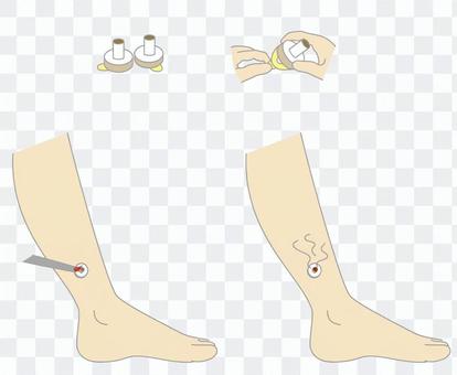 Self moxibustion style Self moxibustion style